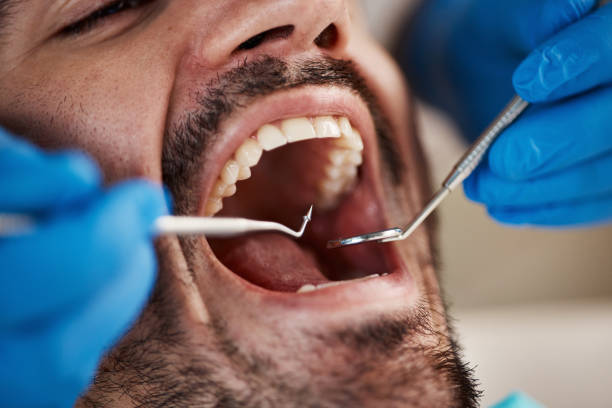 Best Cracked Tooth Emergency Dentist  in Larch Y, WA